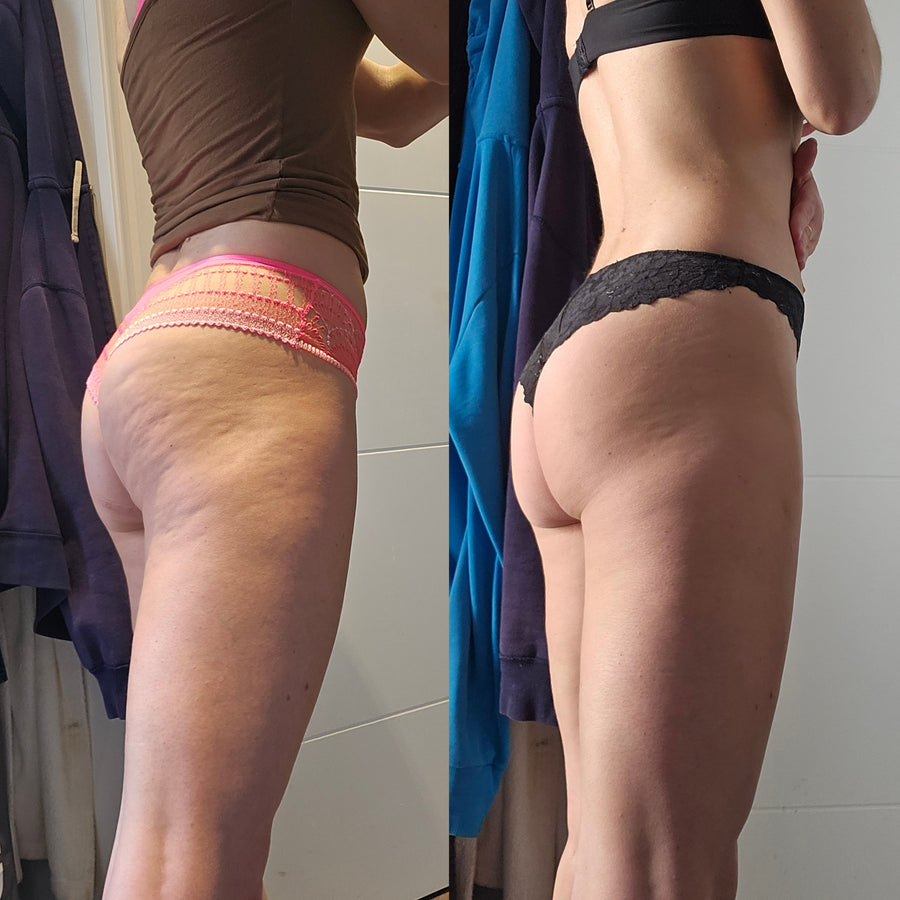 Cellulite