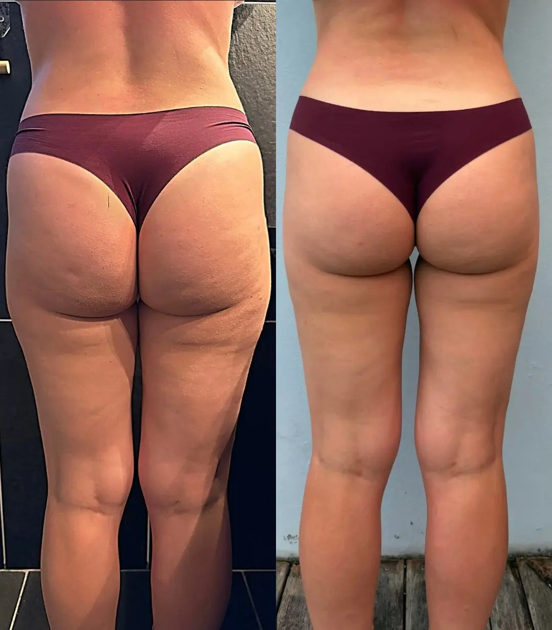 Praxisratgeber: Pressotherapie in eine Anti-Cellulite-Routine integrieren – Eclipse Beauty Tech