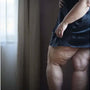 Presoterapia y lipedema: ¿una opción natural para aliviar las molestias? – Eclipse Groupe