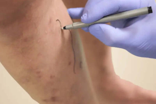 Pressothérapie et varices : une solution efficace ? - Eclipse Groupe