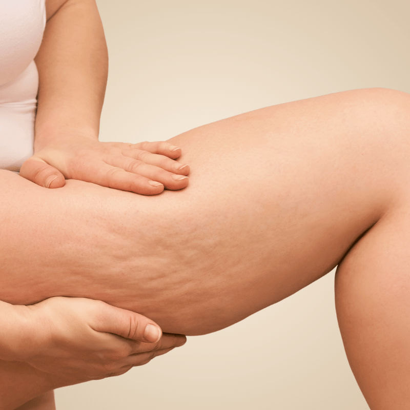 Guide Eclipse consacré à la cellulite